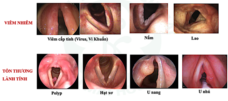 Bất ngờ giọng nói thay đổi, rất có thể do tổn thương nguy hiểm  - Ảnh 1.