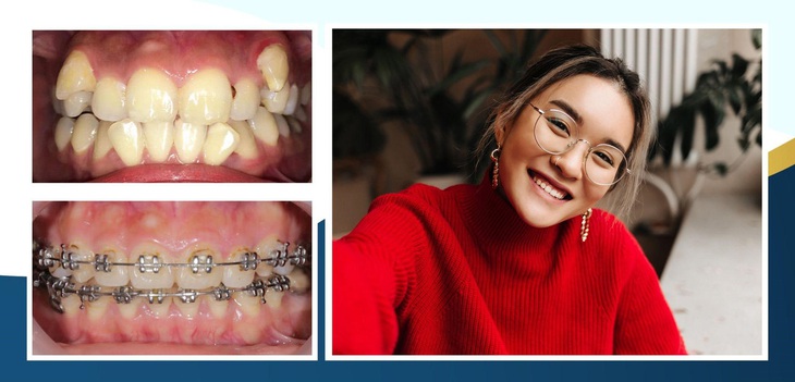 "Niềng răng mắc cài kim lại duy trì sức hút bằng cách nào?" - Ảnh 1.