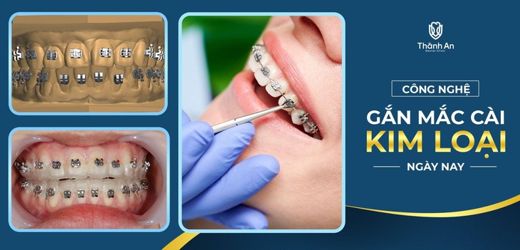 "Niềng răng mắc cài kim lại duy trì sức hút bằng cách nào?" - Ảnh 2.
