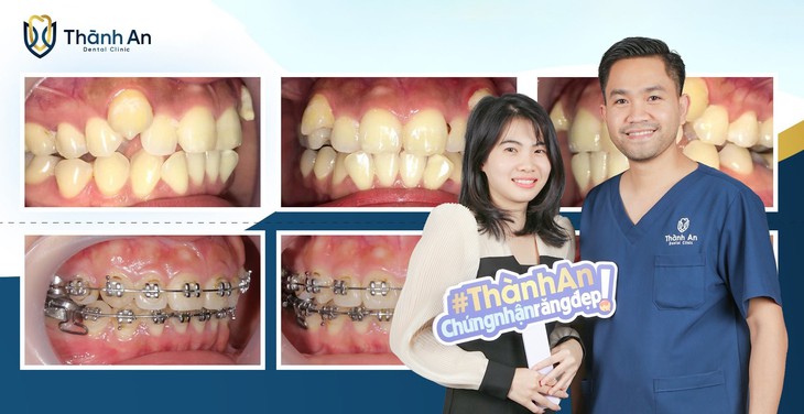 "Niềng răng mắc cài kim lại duy trì sức hút bằng cách nào?" - Ảnh 3.