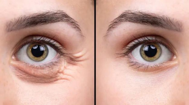 botox