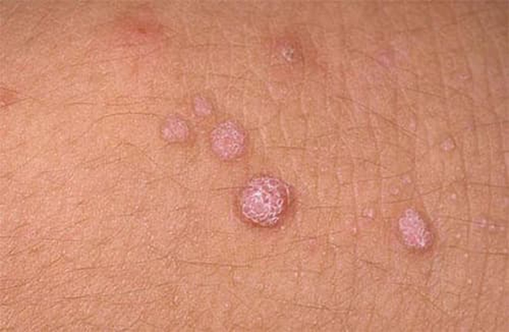 Nam giới bị sùi mào gà là do virut là Human Papillomavirus (HPV).
