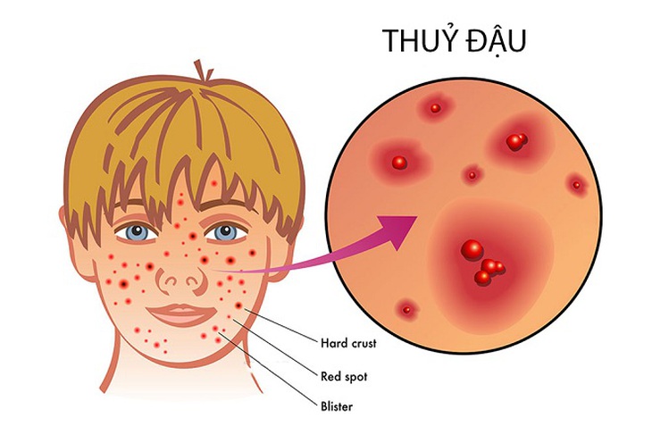 Chăm sóc trẻ bị thủy đậu đúng cách và những sai lầm thường gặp - Ảnh 2. Chăm sóc trẻ bị thủy đậu đúng cách và những sai lầm thường gặp - Ảnh 2.