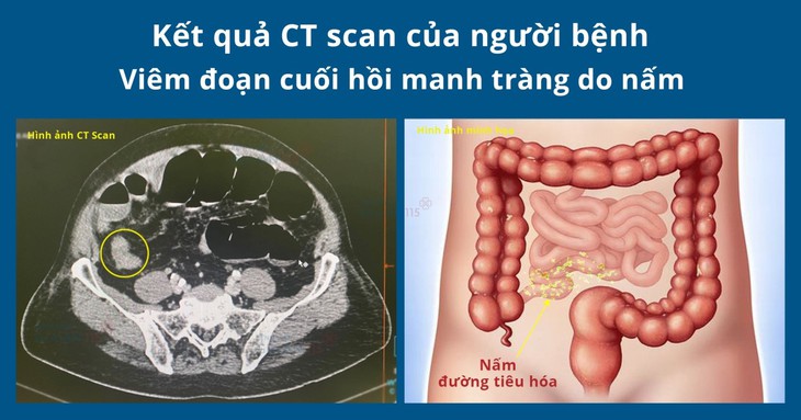 Cảnh giác với bệnh lý nguy hiểm hiếm gặp: Viêm ruột hoại tử - Ảnh 1.