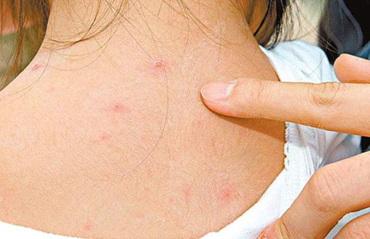 Hiện nay chưa có thuốc đặc trị bệnh các phương pháp và thuốc điều trị hiện tại chỉ có tác dụng hỗ trợ điều trị, phòng ngừa tối đa biến chứng do bệnh thủy đậu gây ra. Hiện nay chưa có thuốc đặc trị bệnh các phương pháp và thuốc điều trị hiện tại chỉ có tác dụng hỗ trợ điều trị, phòng ngừa tối đa biến chứng do bệnh thủy đậu gây ra.