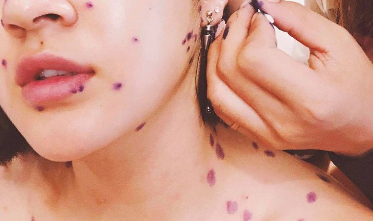 Người lớn có mắc bệnh thủy đậu? cách nhận biết và điều trị - Ảnh 3. Người lớn có mắc bệnh thủy đậu? cách nhận biết và điều trị - Ảnh 3.