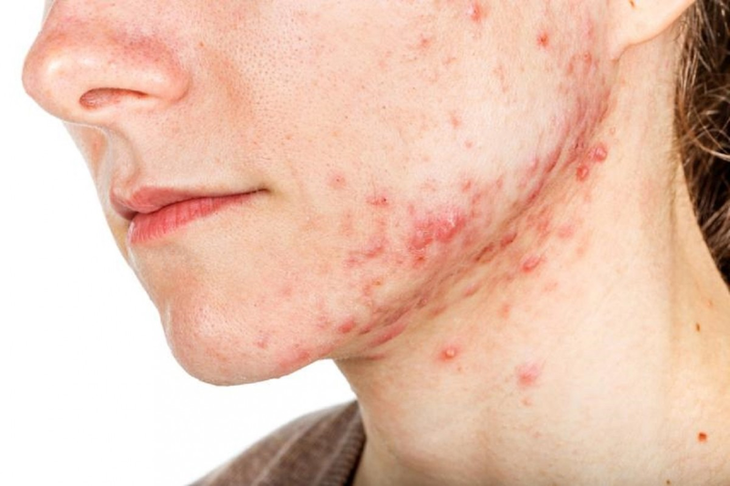 Người lớn có mắc bệnh thủy đậu? cách nhận biết và điều trị - Ảnh 2. Người lớn có mắc bệnh thủy đậu? cách nhận biết và điều trị - Ảnh 2.