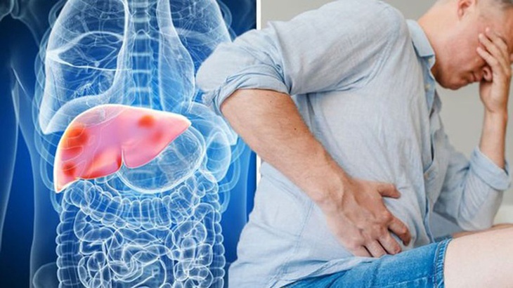 Những điều cần biết về xơ gan và ung thư gan - Ảnh 3.