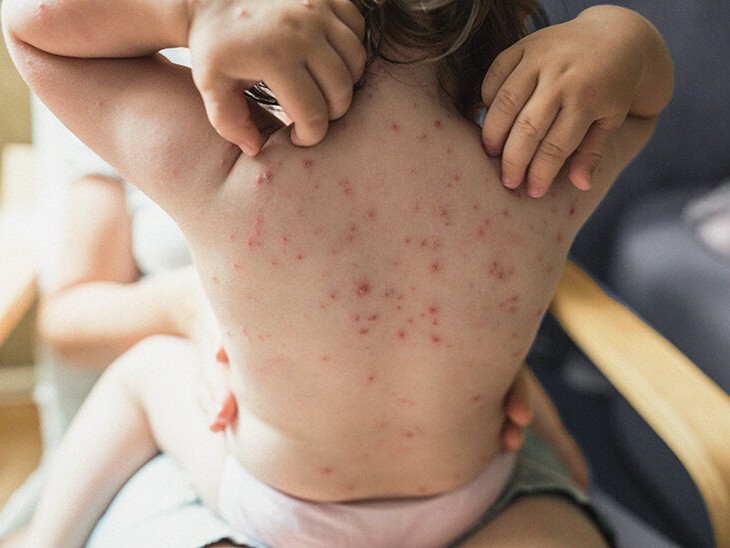 Thuỷ đậu vào mùa, cần lưu ý gì khi dùng thuốc? - Ảnh 1. Thuỷ đậu vào mùa, cần lưu ý gì khi dùng thuốc? - Ảnh 1.