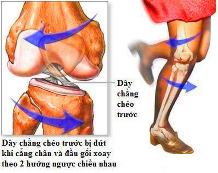 Nhận biết đứt (rách) dây chằng: nguyên nhân và điều trị  - Ảnh 2.