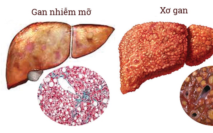 Coi chừng gan nhiễm mỡ có thể gây xơ gan, ung thư gan