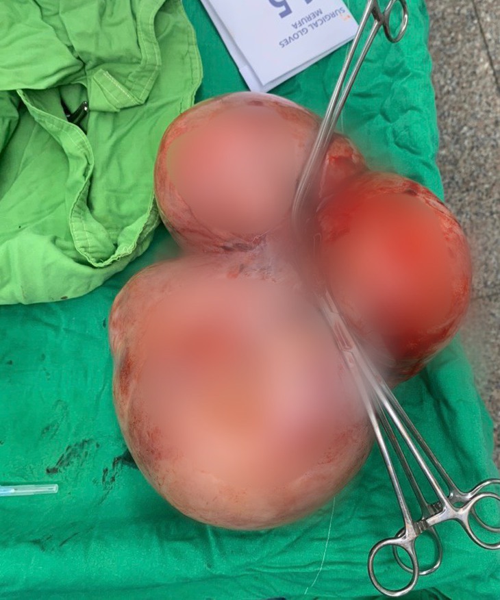 Bụng to bất thường, đi khám phát hiện khối u  5,5 kg - Ảnh 2.