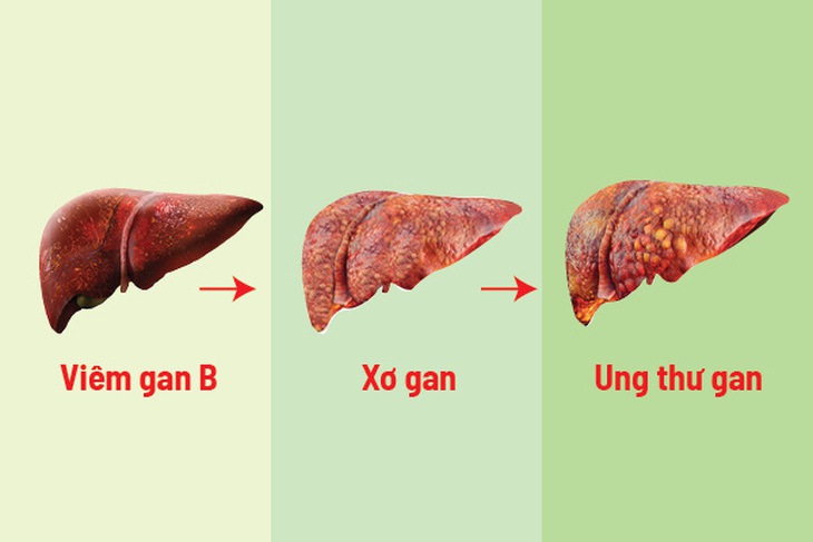 Những điều cần biết về xơ gan và ung thư gan - Ảnh 1.