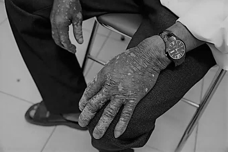 Thuốc trừ sâu ngấm qua quần áo, người đàn ông phồng rộp toàn thân - Ảnh 1. Thuốc trừ sâu ngấm qua quần áo, người đàn ông phồng rộp toàn thân - Ảnh 1.