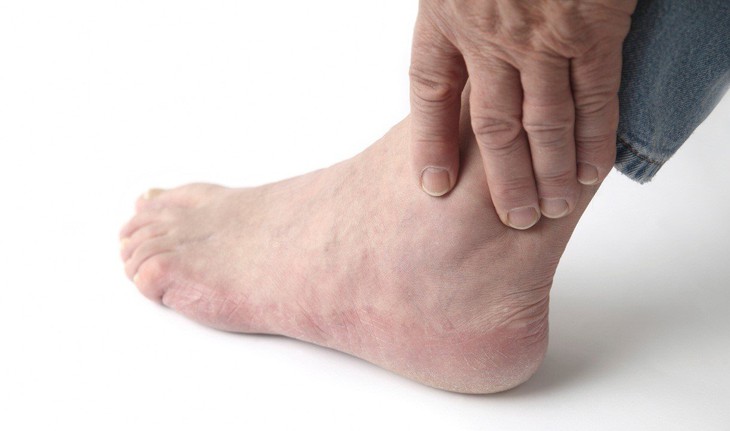 Nhận biết và xử trí khi bị bong gân? - Ảnh 3.