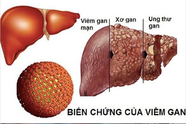 Khoảng 8,8 triệu người Việt bị căn bệnh 'diễn biến thầm lặng nhưng hậu quả rất nghiêm trọng' - Ảnh 1. Khoảng 8,8 triệu người Việt bị căn bệnh 'diễn biến thầm lặng nhưng hậu quả rất nghiêm trọng' - Ảnh 1.