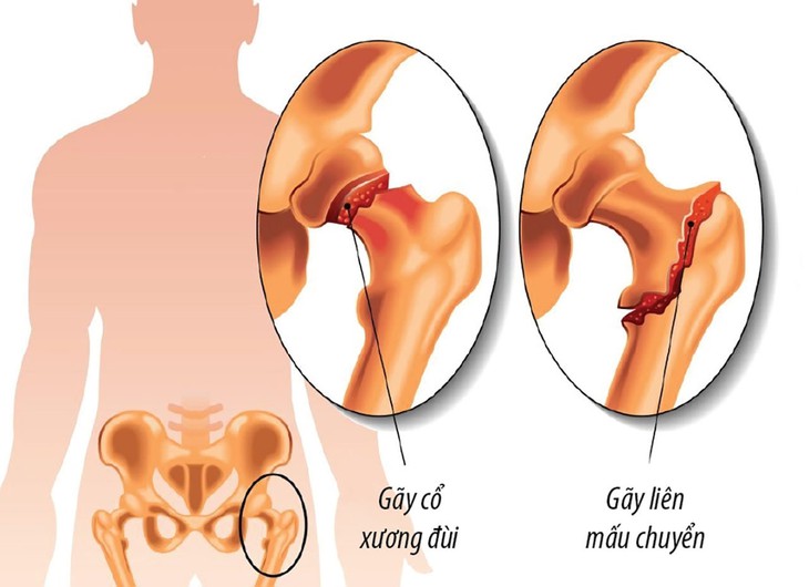 Sự nguy hiểm khi người cao tuổi bị gãy cổ xương đùi - Ảnh 2. Sự nguy hiểm khi người cao tuổi bị gãy cổ xương đùi - Ảnh 2.