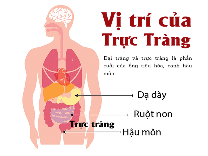 Chuyên gia chỉ cách đơn giản giúp bạn nhận biết sớm dấu hiệu ung thư đại trực tràng - Ảnh 1. Chuyên gia chỉ cách đơn giản giúp bạn nhận biết sớm dấu hiệu ung thư đại trực tràng - Ảnh 1.