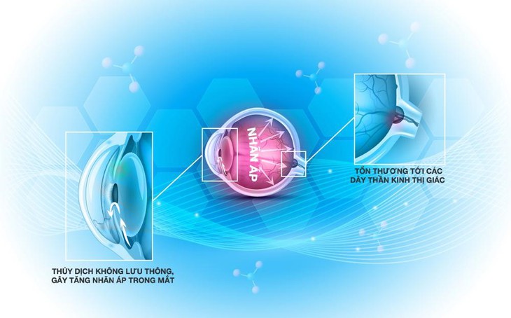 Điều trị glôcôm dưới góc nhìn của chuyên gia     - Ảnh 1.
