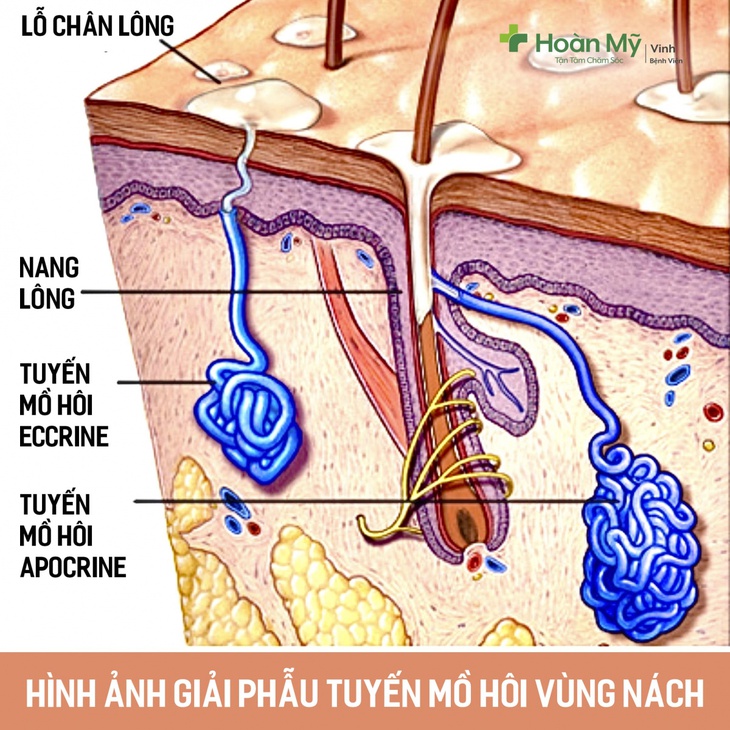 Hôi nách: Nguyên nhân, phương pháp điều trị và những lưu ý - Ảnh 2.