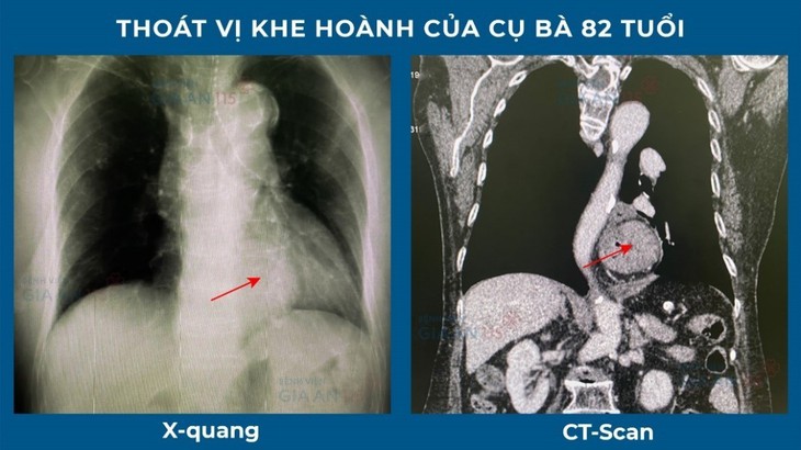Thoát vị khe hoành bị chẩn đoán nhần thành suy tim-Cụ bài suốt 10 năm bị điều trị sai bệnh - Ảnh 2. Thoát vị khe hoành bị chẩn đoán nhần thành suy tim-Cụ bài suốt 10 năm bị điều trị sai bệnh - Ảnh 2.