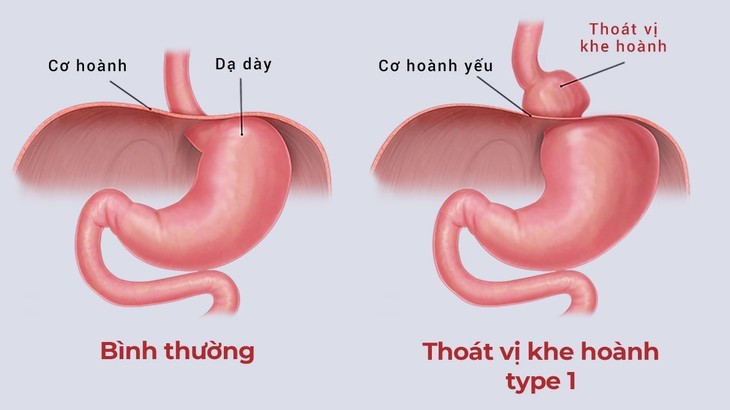 Thoát vị khe hoành bị chẩn đoán nhần thành suy tim-Cụ bài suốt 10 năm bị điều trị sai bệnh - Ảnh 3. Thoát vị khe hoành bị chẩn đoán nhần thành suy tim-Cụ bài suốt 10 năm bị điều trị sai bệnh - Ảnh 3.