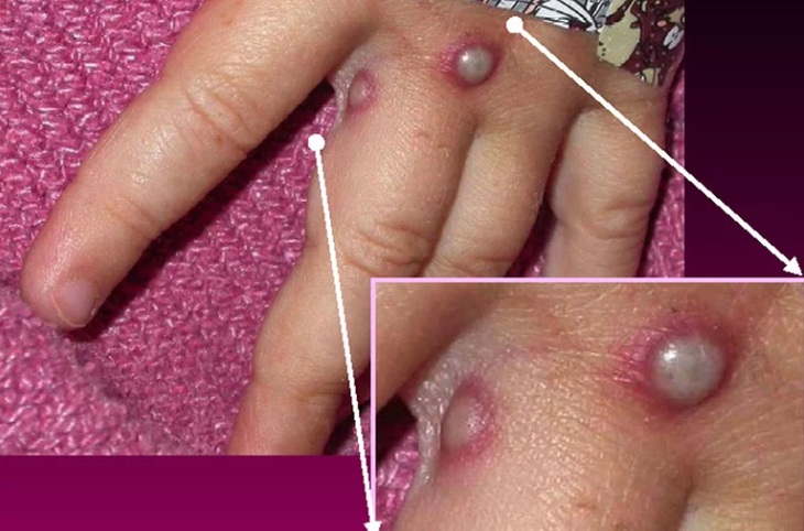 Bùng phát ổ dịch đậu mùa khỉ hiếm gặp ở Anh quốc, Mỹ và châu Âu - Ảnh 1. Bùng phát ổ dịch đậu mùa khỉ hiếm gặp ở Anh quốc, Mỹ và châu Âu - Ảnh 1.