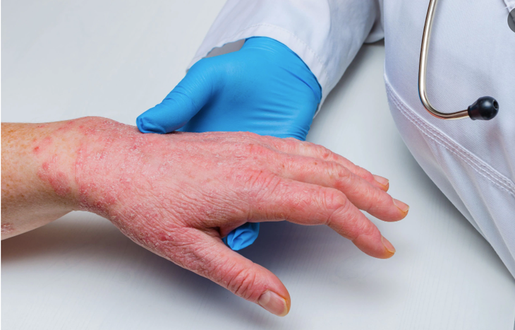Bệnh đậu mùa khỉ: Virus gây bệnh nguy hiểm như thế nào? - Ảnh 4. Bệnh đậu mùa khỉ: Virus gây bệnh nguy hiểm như thế nào? - Ảnh 4.