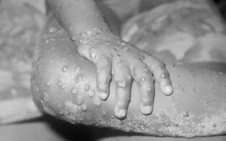 Triệu chứng của bệnh đậu mùa khỉ, điều trị và phòng ngừa