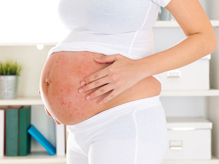 Đối với những bệnh nhân vảy nến mức độ trung bình đến nặng nên trì hoãn mang thai.