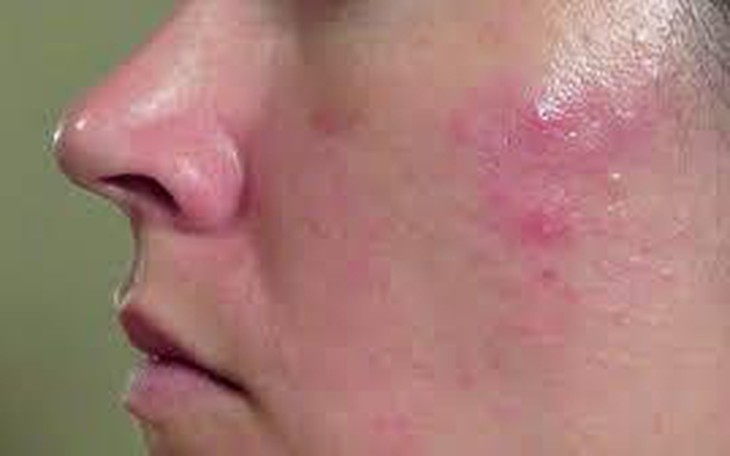 Điều trị viêm da tiết bã nhờn bằng đông y