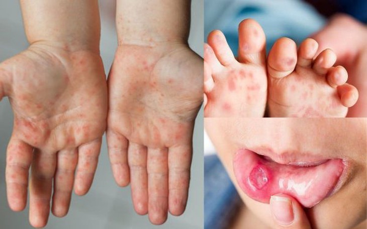 Khẩn: Đã có 5.545 ca mắc tay chân miệng, 1 trường hợp tử vong, Bộ Y tế dự báo dịch có thể gia tăng