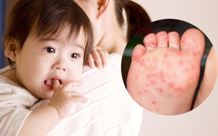 Những điều cha mẹ cần lưu ý khi chăm sóc trẻ mắc bệnh tay chân miệng