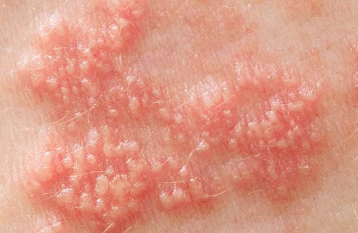 Nhận biết và phòng ngừa Herpes sinh dục - Ảnh 2. Nhận biết và phòng ngừa Herpes sinh dục - Ảnh 2.