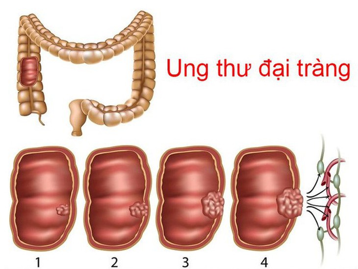 5 điều cần biết để phòng ung thư đại tràng - Ảnh 1.
