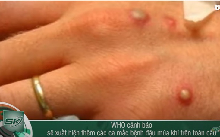 WHO cảnh báo bệnh đậu mùa khỉ lây nhiễm giữa người với người tiếp xúc trực tiếp