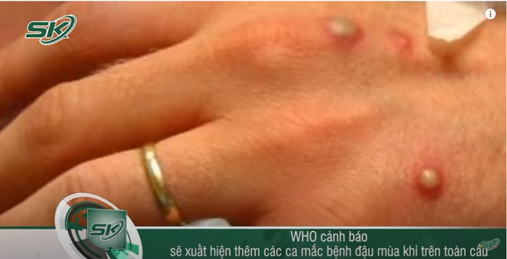 6 hiểu nhầm phổ biến về bệnh đậu mùa khỉ - Ảnh 1. 6 hiểu nhầm phổ biến về bệnh đậu mùa khỉ - Ảnh 1.