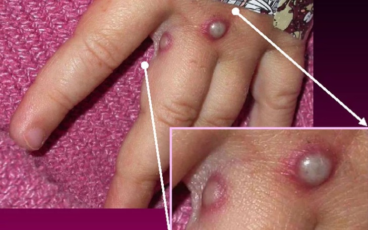 Dịch đậu mùa khỉ "nóng" trên thế giới, Bộ Y tế yêu cầu giám sát, phát hiện ca nghi ngờ tại cửa khẩu, cơ sở y tế