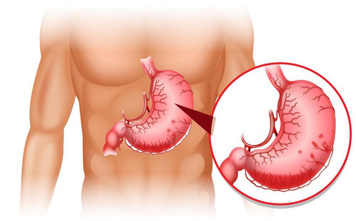Điểm mặt các bất thường về đau dạ dày cần tới bác sĩ - Ảnh 2. Điểm mặt các bất thường về đau dạ dày cần tới bác sĩ - Ảnh 2.