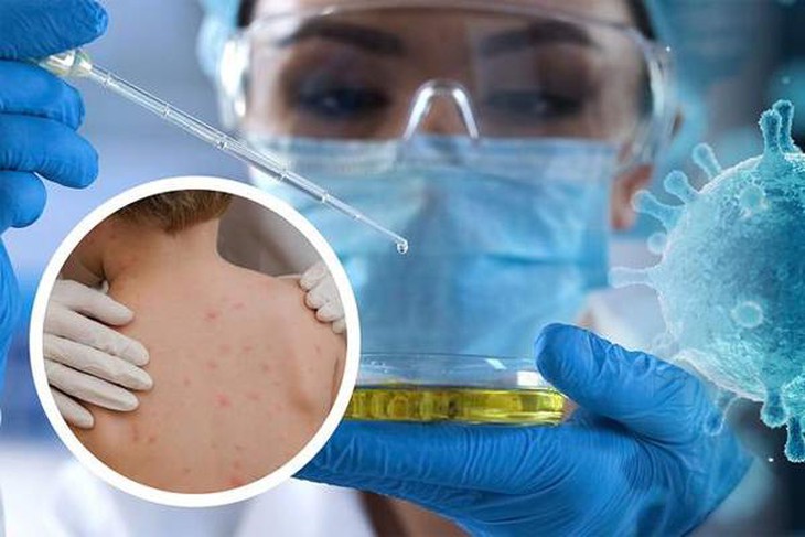 Cảnh giác với bệnh đậu mùa khỉ - Ảnh 2. Cảnh giác với bệnh đậu mùa khỉ - Ảnh 2.
