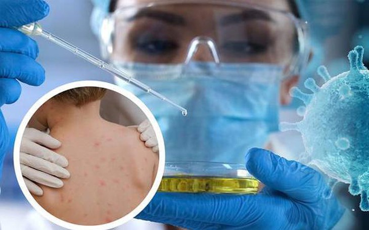 Bệnh đậu mùa khỉ: Đường lây truyền và cách phòng ngừa cần làm ngay