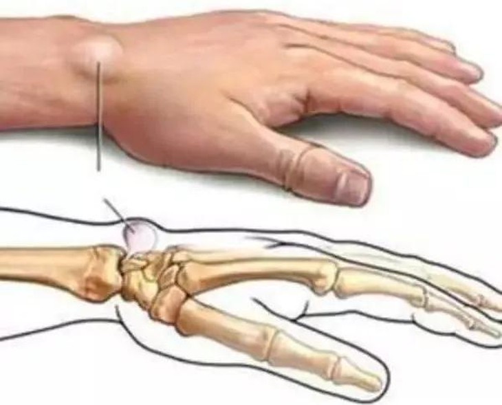 Ung thư xương nguyên phát- Phát hiện và điều trị - Ảnh 4.