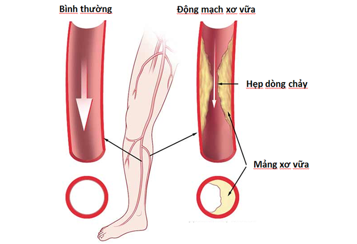 Hoại tử nặng vì đắp lá chữa tắc động mạch chi dưới - Ảnh 1.