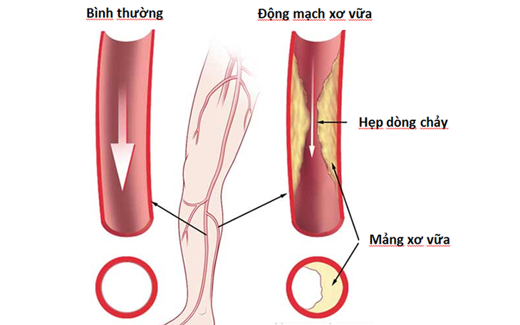 Hoại tử nặng vì đắp lá chữa tắc động mạch chi dưới