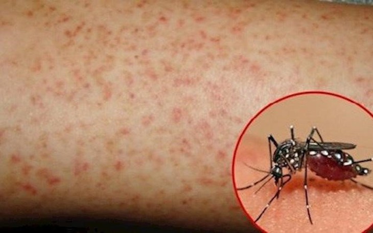 Coi chừng biến chứng nguy hiểm của sốt xuất huyết ngày mưa 