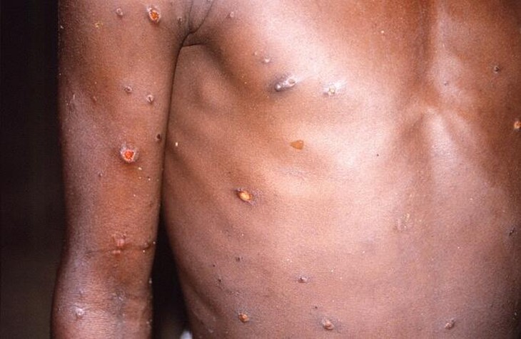Bệnh đậu mùa khỉ lan ra hơn 20 nước, phát hiện mới về thuốc chữa virus - Ảnh 3.