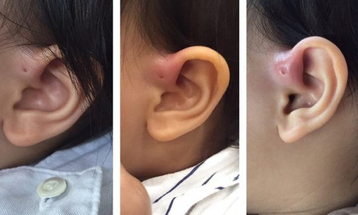 Rò luân nhĩ bị viêm nhiễm và những điều bạn cần biết. - Ảnh 2.