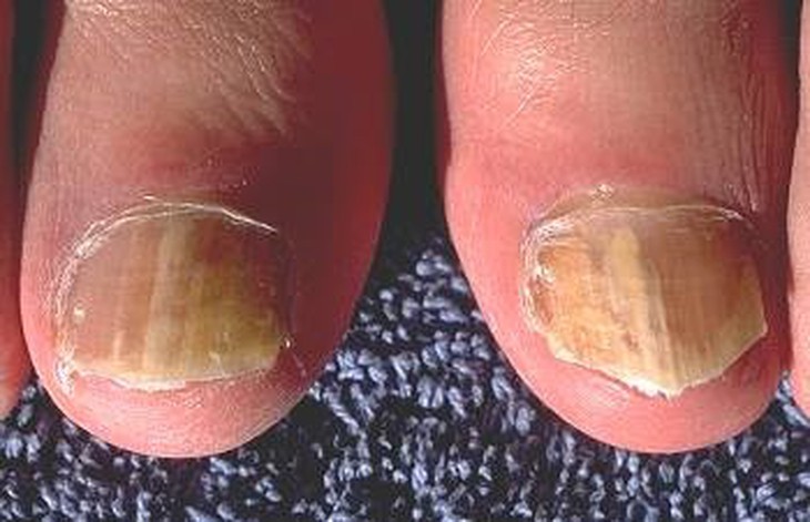 Nấm móng - cách nào trị dứt điểm? - Ảnh 1.
