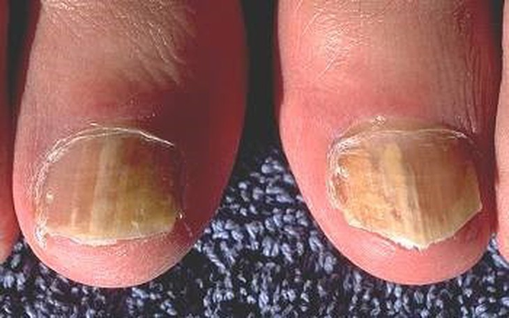 Nấm móng tay và chữa trị dứt điểm