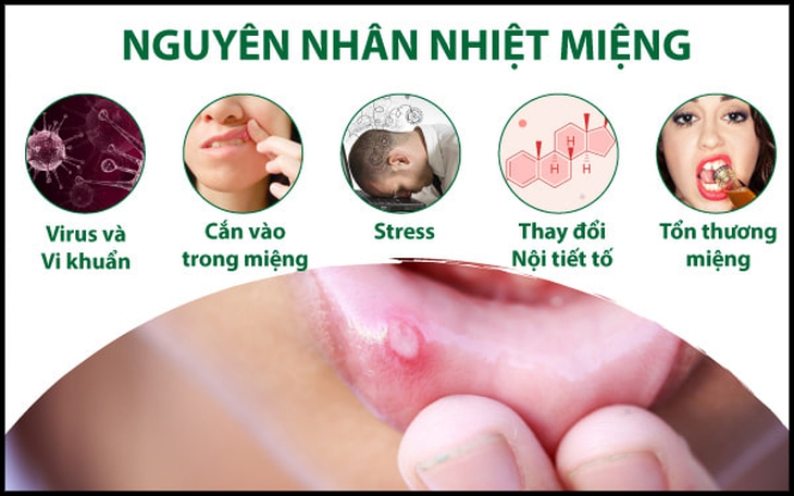 Nhiệt miệng và những hiểu sai cần tránh - Ảnh 2.